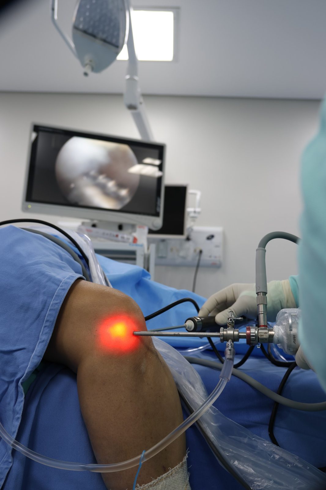Artroscopia de joelho realizada pelo Dr. Rafael Sena