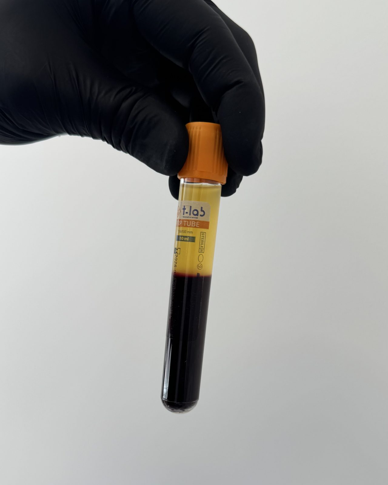 Tubo de PRP preparado no consultório